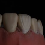 zęby z kamieniem przy dziąsłach