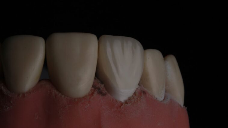 zęby z kamieniem przy dziąsłach